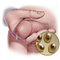 chlamydia váladék